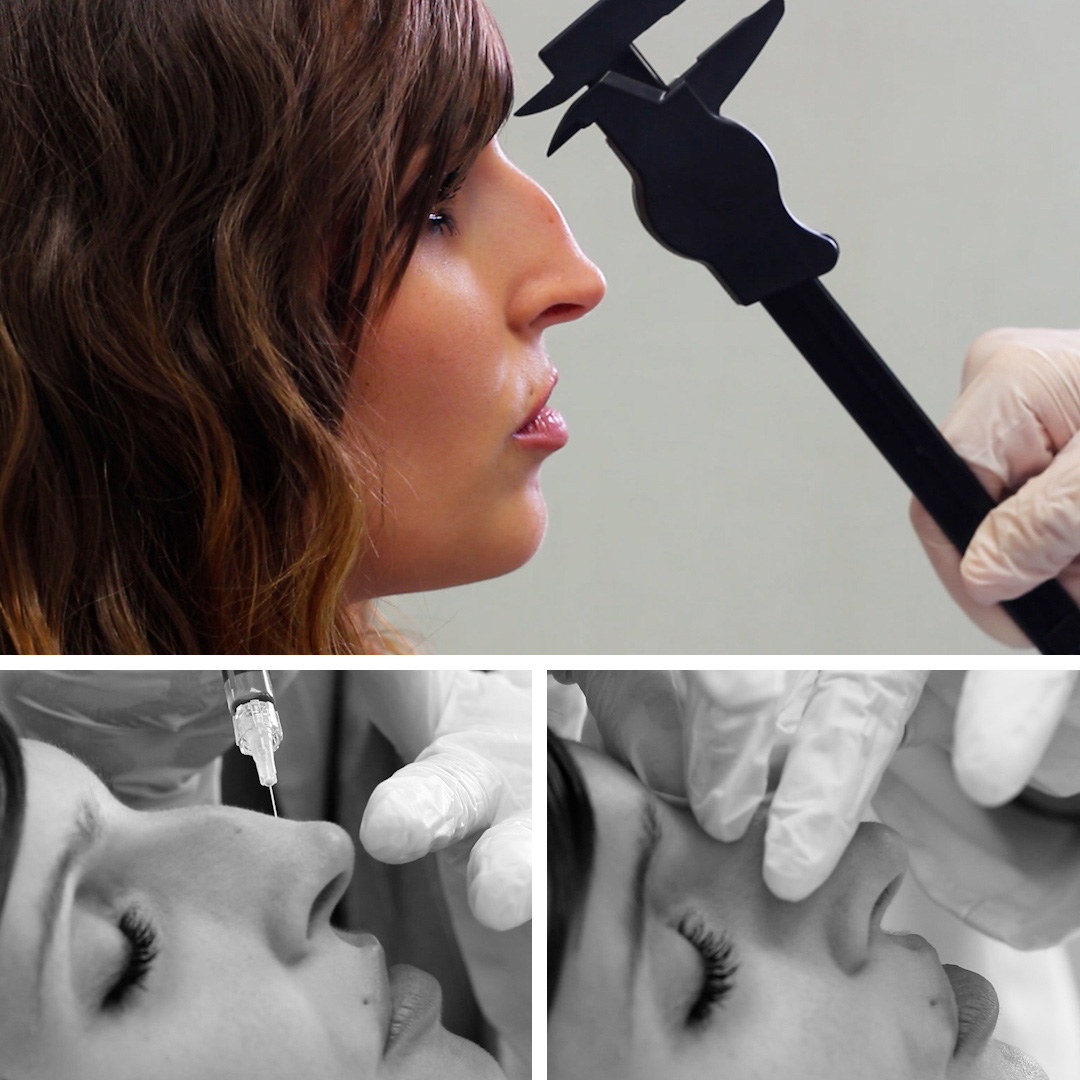 RINOMODELACIÓN: Rediseña tu nariz en 15 minutos