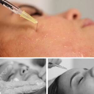 mesoterapia-vitaminas-clinicas-diego-de-leon