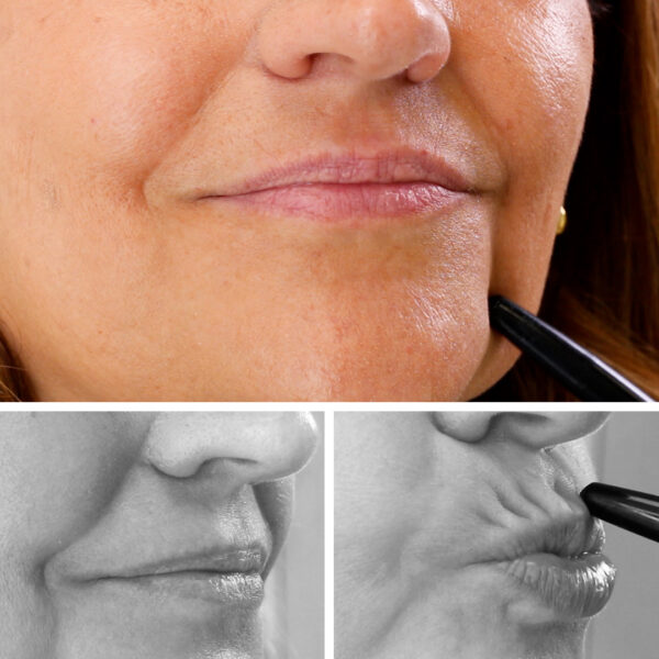 LIP LINES: Rejuvenece surco nasogeniano, código de barras o líneas de marioneta