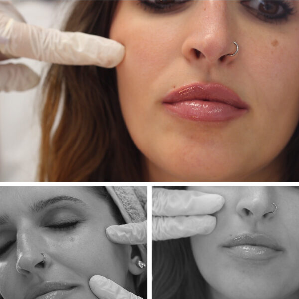 LIFTING 3D: Estimulador de Colágeno